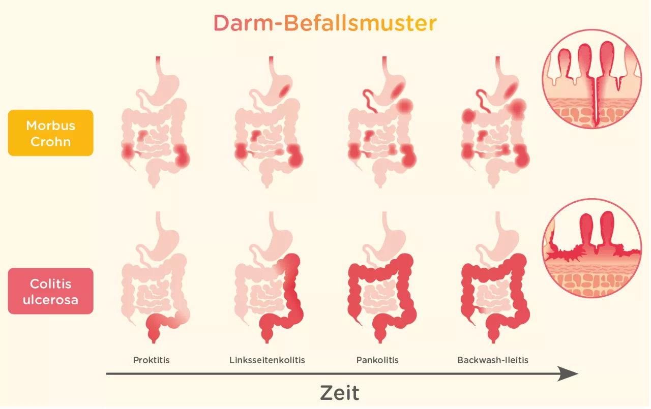 Wo Liegen Die Unterschiede Zwischen Morbus Crohn Und Colitis Ulcerosa?